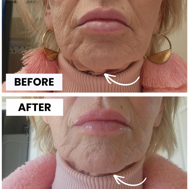 NORA Face Shaper