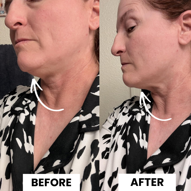 NORA Face Shaper